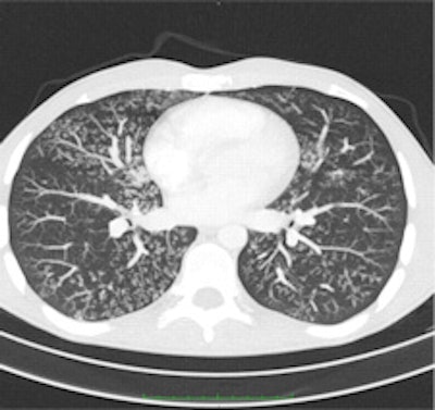 Maximum intensity projection