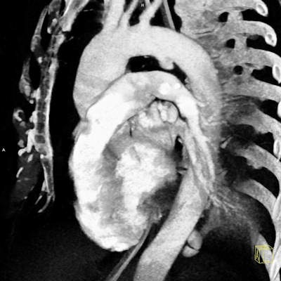 Postcontrast chest CT, black-and-white volume rendering reconstruction, sagittal view. Aortic isthmus laceration -- pseudoaneurysm in a typical location.
