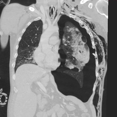 Chest CT, coronal reformation in the lung window. Left-sided tension pneumothorax, extensive contusion of the left lung with lacerations and subcutaneous emphysema of the left hemithorax. All images courtesy of Dr. Hynek Mirka, PhD.