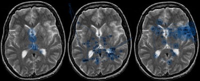 This eye-tracking overlay was designed to avoid visual and cognitive errors, and was developed at the University of Loughborough. It was originally presented at the SPIE 2010 meeting. Image courtesy of Lindsey Cooper, Alastair Gale, PhD, and Dr. Adoni Toms.
