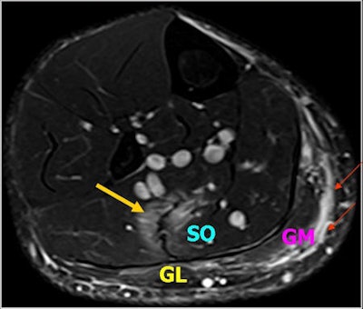 A 28-year-old man presented with right calf pain. Axial fat-saturated T2-weighted turbo spin-echo image demonstrate an area of hyperintensity with feathery appearance, consistent with a grade 1 injury (strain) of soleus muscle (yellow arrow). There is also epifascial hematoma and edema at the posterior aspects of the medial gastrocnemius (red arrows). SO = soleus; GM = medial head of gastrocnemius; GL = lateral head of gastrocnemius.