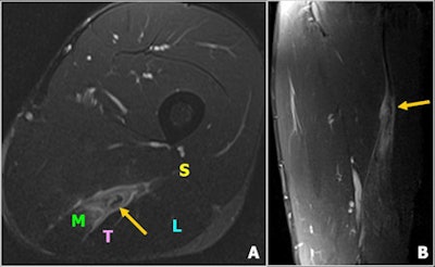 A 24-year-old tennis player presented with left posterior thigh pain. Clinically, the lesion was diagnosed as a grade 2 injury. Axial fat-saturated T2-weighted turbo spin-echo image (A) and coronal short-tau inversion-recovery image (B) show a partial tear without retraction (grade 2 injury, yellow arrow) of the musculotendinous junction of the semimembranosus muscle. The tear measured 6 x 2 x 1.8 cm in size. S = short head of biceps femoris, L = long head of biceps femoris, M = semimembranosus; T = semitendinosus. All images courtesy of Dr. Daichi Hayashi, PhD.