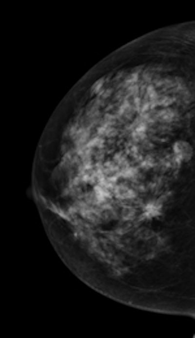 Same patient viewed via craniocaudal mammography