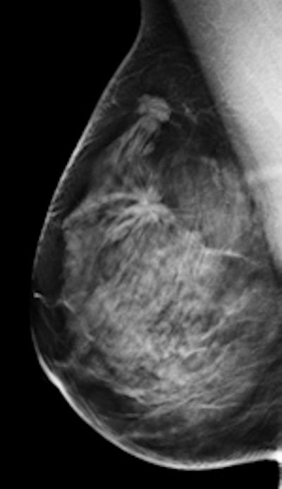 Left: Mediolateral oblique view of a patient with two malignant masses (invasive ductal carcinomas) using mammography. Center: Same patient viewed via craniocaudal mammography. Right: Same patient viewed on DBT. The spicules and tumor structures are better depicted by DBT. Copyright Dr. Gisella Gennaro.