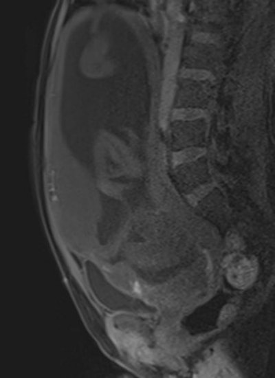 Sagittal T1-weighted volume interpolated gradient-echo MR image evidences focal hyperintense signal intensity of the placenta, compatible with recent hemorrhages.
