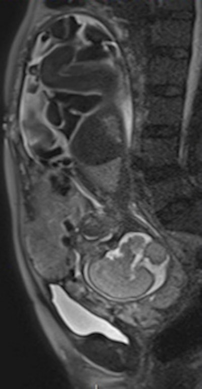 Sagittal T2-weighted single-shot fast spin-echo MR images show the placenta previa and evidence focal bulgings of the anterior uterine wall