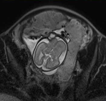 Axial T2-weighted single-shot fast spin-echo MR image shows an irregular outer uterine contour with discontinuity of the T2-hypointense myometrial layer in the anterior uterine segment. All images courtesy of Dr. Leonor Alamo.