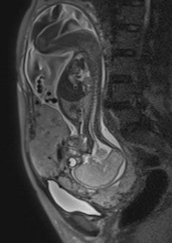Sagittal T2-weighted single-shot fast spin-echo MR images show the placenta previa and evidence focal bulgings of the anterior uterine wall. The signal intensity of the placenta is heterogeneous, with presence of T2-hypointense placental bands. Observe the discontinuity of the myometrial layer, extending beyond the uterine serosa.