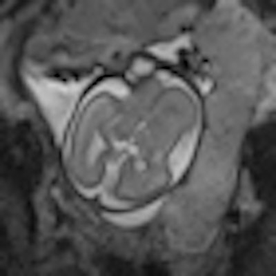 2012 10 08 08 07 26 925 2012 10 08 Placental Mri Thumb2