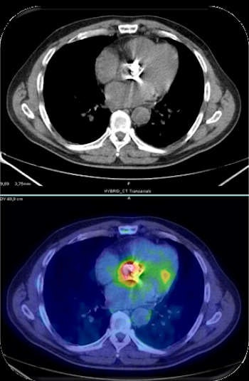 FDG-PET/CT scan of a human patient shows prosthetic valve endocarditis.