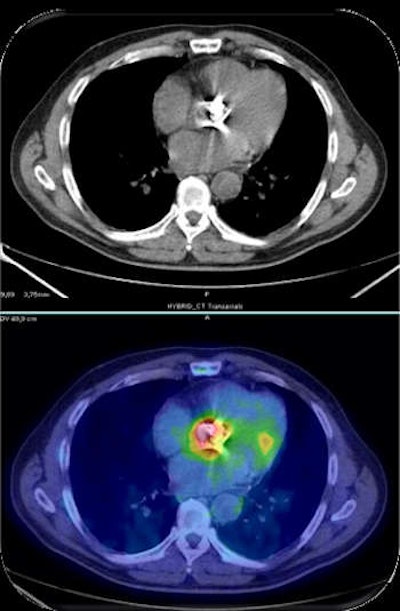 FDG-PET/CT scan of a human patient shows prosthetic valve endocarditis.