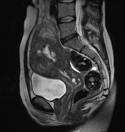 Adenomyosis and intramural leiomyomas: Conventional T2-weighted image