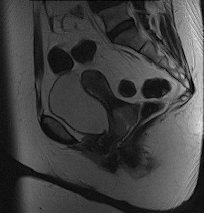 Cervical carcinoma: The uterine zonal anatomy and bladder wall as well as the bowel loops are more sharply delineated on the BLADE image (right); however, SNR and CNR are higher on the conventional T2-weighted image (left).
