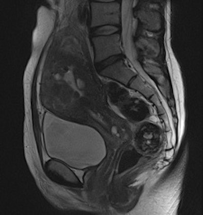 Adenomyosis and intramural leiomyomas: The intramural uterine changes, cervical structures, and bladder wall are more sharply delineated on the BLADE sequence (right); however, SNR and CNR are higher on the conventional T2-weighted image (left). There are also fewer motion artifacts in the surrounding tissue on the BLADE image.