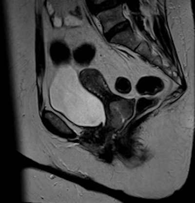 Cervical carcinoma: imageConventional T2-weighted image
