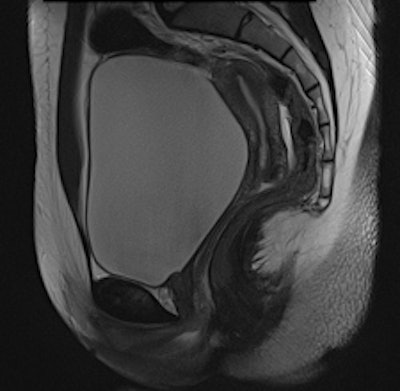 The uterine zonal anatomy and cervix are more sharply delineated on the BLADE image (right); however, SNR and CNR are higher on the conventional T2-weighted image (left). All images courtesy of Dr. Bianka Freiwald-Chilla.