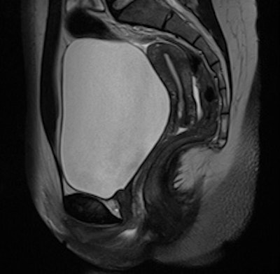 Uterine zonal anatomy and cervix: Conventional T2-weighted image