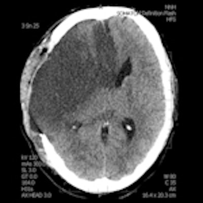 A 28-year-old male with a history of aortic valve replacement and poor compliance with anticoagulative medication, presented with sudden left-sided hemiplegia. No penumbra was apparent on perfusion CT, as shown in left figure (CBF) and middle figure (CBV). Standard CT image (right figure) two days following decompressive craniectomy shows significant mass effect with dislocation of midline structures. Images courtesy of Dr. Josef Vymazel.