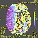 Perfusion CT