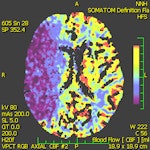 Perfusion CT