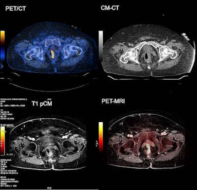 Left-sided, FDG-avid rectal cancer with rectal wall thickening. Note the improved detectability of the surrounding infiltration and detectability of the small locoregional lymph node. Images courtesy of Dr. Veit-Haibach.