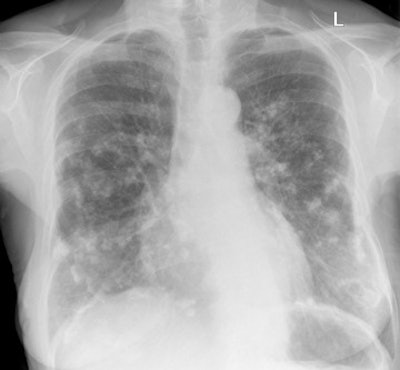 Digital chest x-ray of female patient shows multiple calcified pleural plaques caused by asbestos exposure. Plaques are also seen along the diaphragm.