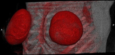CT images of a patient with Poly Implant Prothèse (PIP) implants on both sides. The silicone signal is encoded in red. There is a small leak on the medial dorsal aspect of the left implant. The enlarged left axillary lymph nodes show a strong silicone signal. Top: Lateral oblique view. Bottom: Frontal view. All images courtesy of Dr. Thorsten R. C. Johnson.