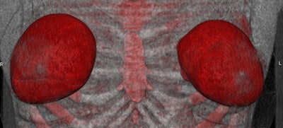 Frontal view of patient with implants