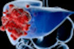 2012 10 30 12 30 04 839 Liver Cancer 70
