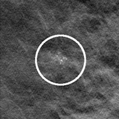Left: Example of a breast tomosynthesis slice holding a simulated mass. Right: Example of a breast tomosynthesis slice holding a simulated microcalcification cluster. All images courtesy of Dr. Pontus Timberg.