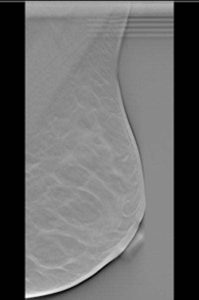 Example of the ViewDEX user interface showing a breast tomosynthesis slice in vertical position.