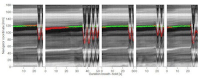 The five consecutive breath-holds of a patient set out after each other in one image. The green dots indicate the navigator results that are within 2 mm from the reference position and the red dots indicate the results further than 2 mm from the reference. If the edge is close to the threshold of 2 mm, the noise on the detection becomes apparent because the results seem to be oscillating around the threshold, shown as a mixture of red and green dots in the image.