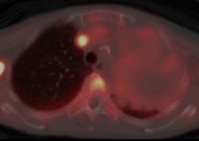 An example of a patient with non-small cell lung cancer showing relatively high C-11 docetaxel uptake in a tumor with a volume of 334 cm3. During the therapeutic scan, the patient was treated with 110 mg of docetaxel. Left: CT scan showing tumor. Right: PET/CT fusion image of a therapeutic C-11 docetaxel summed image [25-65 min; mean C-11 docetaxel Ki = 0.0125 mL·cm-3·min-1; total accumulated amount of cold docetaxel at 90 min = 543 µg (at 1.62 µg·cm-3), corresponding with 0.49% of the infused dose docetaxel]. Images courtesy of Dr. Astrid van der Veldt, PhD.