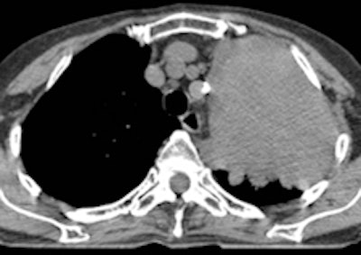 CT scan showing tumor