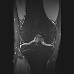 3D SPACE sequence performed at 3 tesla in a 21-year-old man. All scans are 1-mm multiplanar reformatted images in the sagittal (left), axial (middle), and coronal (right) plane. The patient had no abnormalities at arthroscopy. This case illustrates that all relevant structures (menisci, ligaments, and cartilage) can be visualized well using this sequence with good contrast-to-noise ratio between cartilage/meniscus and synovial fluid. All images courtesy of Dr. Pieter Van Dyck.