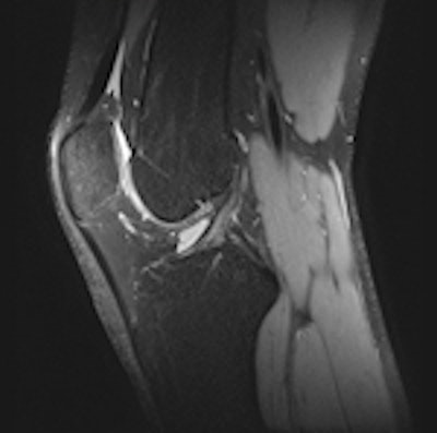 Sagittal knee MRI