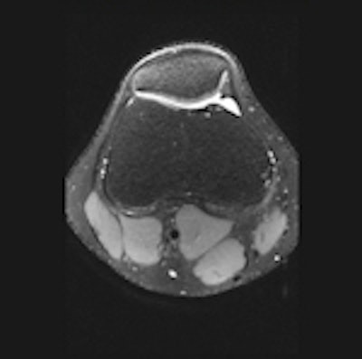 Axial knee MRI