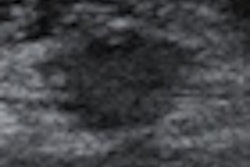 2012 11 15 17 24 23 541 2012 11 16 Breast Us2 Thumb