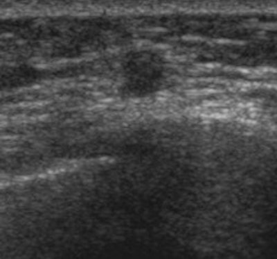 2012 11 15 17 24 24 303 2012 11 16 Breast Us1