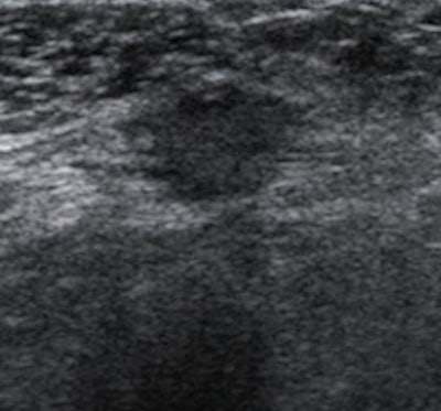 Left: A 47-year-old asymptomatic woman who had undergone a mastectomy. Ultrasound shows a 5-mm round mass with uncircumscribed margins and mild hypoechogenecity at the deep muscle layer of the mastectomy site. Right: A 45-year-old asymptomatic woman who had undergone a mastectomy. Ultrasound shows a 10-mm irregular hypoechoic mass with not-circumscribed margins at the deep muscle layer of the mastectomy site. Recurrent ductal carcinomas were confirmed by a ultrasound-guided core-needle biopsy in both cases. Images courtesy of Dr. Jin Hwa Lee.