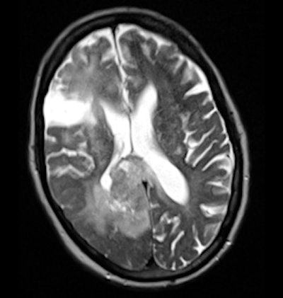 Fig. 1 (left): Noncontrast CT scan of the brain. Fig. 2 (right): Axial T1 postcontrast scan.