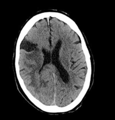 Noncontrast CT scan of the brain
