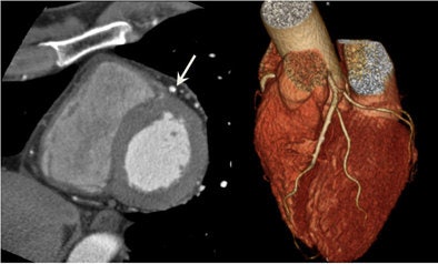A 62-year-old man presented for coronary CT angiography (CCTA) due to chest pain. Free-breathing prospective CCTA images show the clearly defined coronary arteries with calcified plaque (arrows) without motion artifacts. All images courtesy of Dr. Eun-Ju Kang.