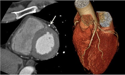 A 62-year-old man presented for coronary CT angiography (CCTA) due to chest pain. Free-breathing prospective CCTA images show the clearly defined coronary arteries with calcified plaque (arrows) without motion artifacts. All images courtesy of Dr. Eun-Ju Kang.