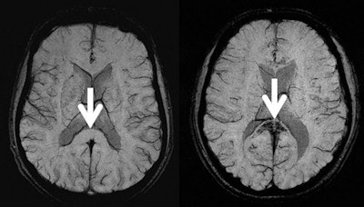 Brain MR images of two mountaineers. Left: A mountaineer who climbed to altitudes above 7,000 meters. Right: A mountaineer who survived a high altitude cerebral edema (HACE). The arrows point to the corpus callosum. This part of the corpus callosum is normal in the left image, whereas in the HACE survivor it shows black spots representing multiple microhemorrhages. Images courtesy of Dr. Michael Knauth, PhD.
