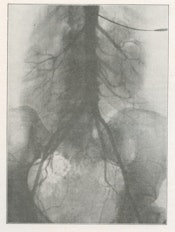 Fig. 7: Translumbar aortography for sigmoid tumor shows abnormal vascularity (1932).