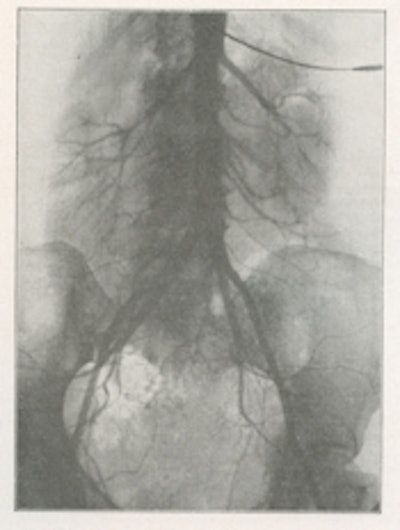 Fig. 7: Translumbar aortography for sigmoid tumor shows abnormal vascularity (1932).