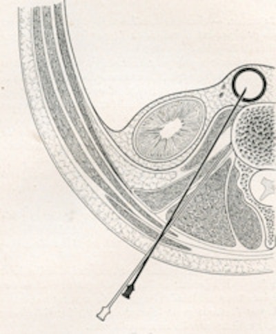 Left, fig. 5: Dos Santos (1932). Right, fig. 6: Technique of aortography (1932).