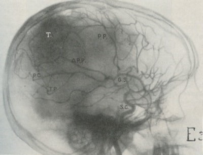 Fig. 4: Cerebral angiography (1932).