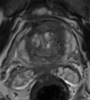 CADx software shows promise for improving detection of prostate cancer lesions originating in the central gland. All images courtesy of Geert Litjens.